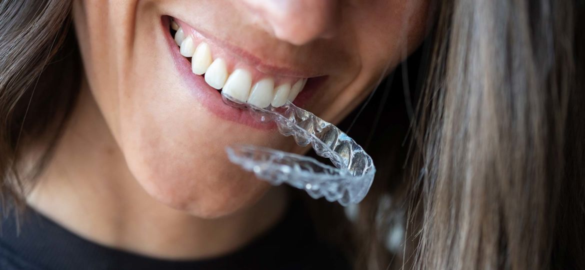 precio-invisalign-madrid-leganes