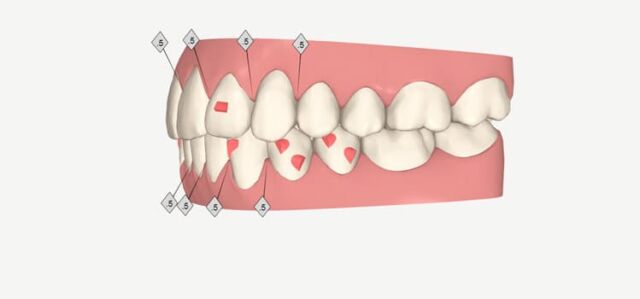 que son los ataches invisalign