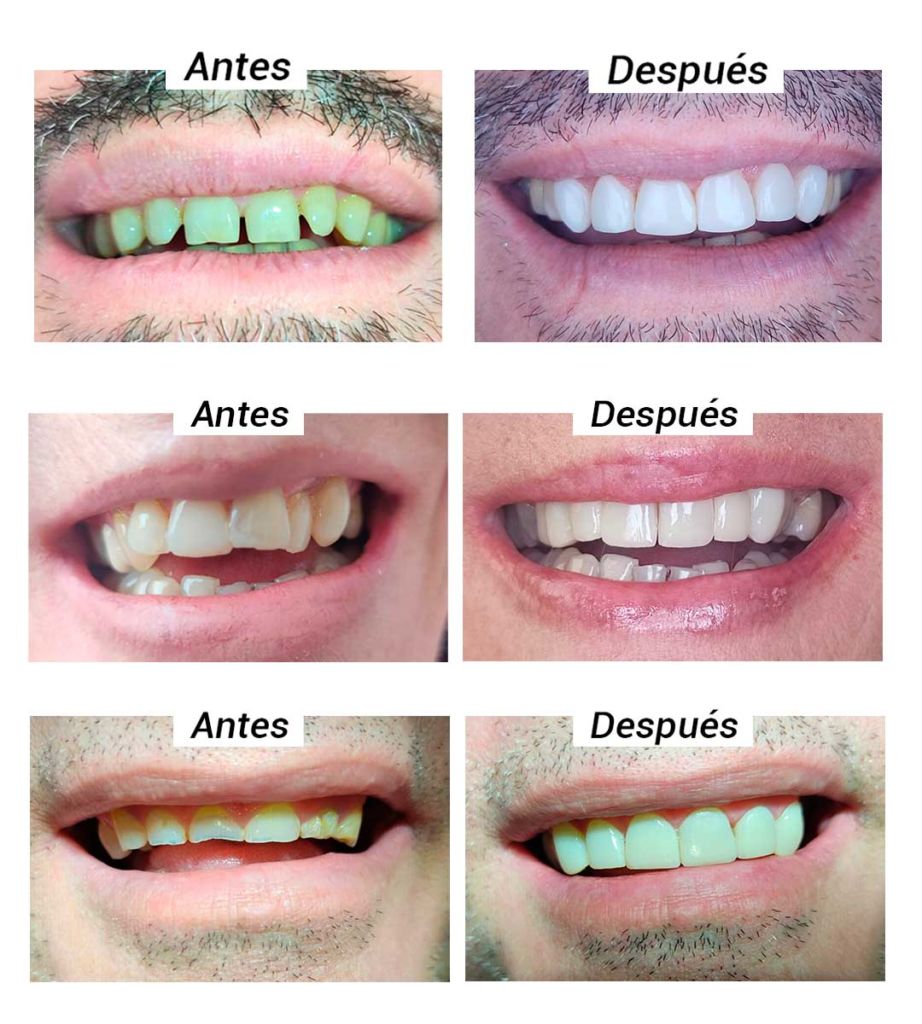 Qué ventajas tienen las carillas dentales?