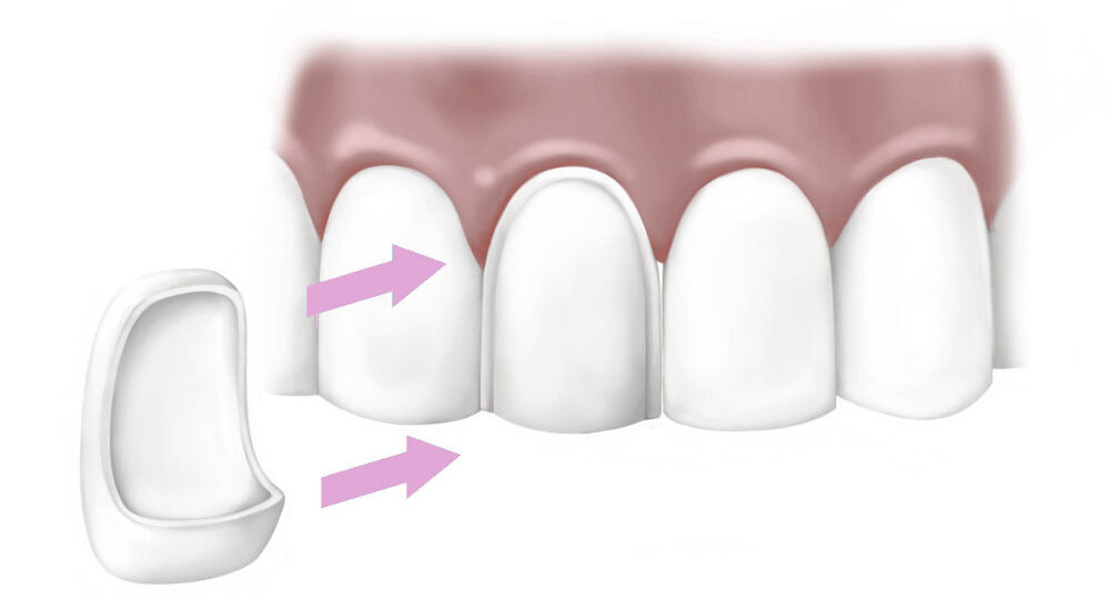 tipos de carillas dentales