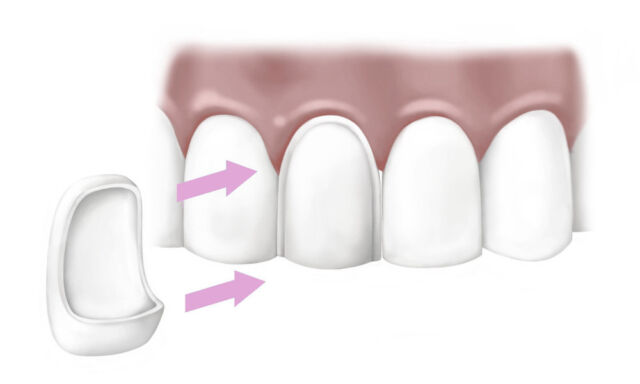 tipos de carillas dentales