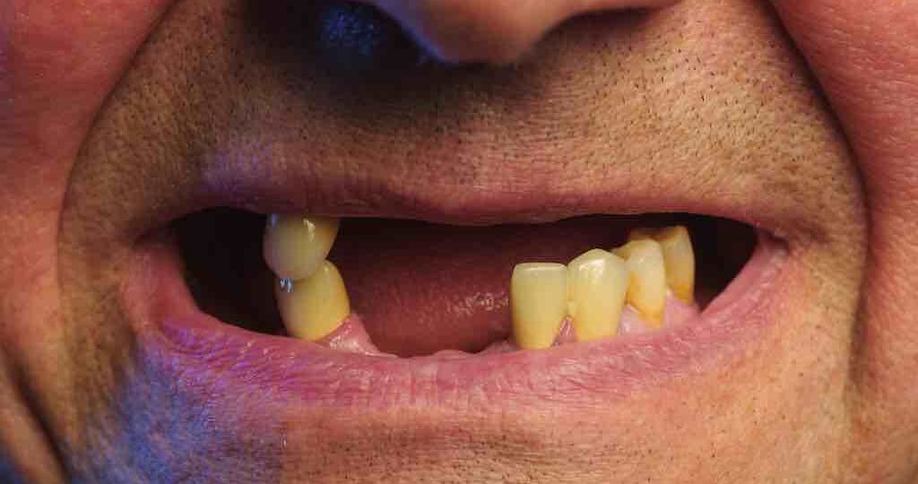 Periodontal,Disease,And,Missing,Teeth,In,An,Elderly,Man.,Close