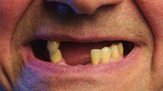 Periodontal,Disease,And,Missing,Teeth,In,An,Elderly,Man.,Close