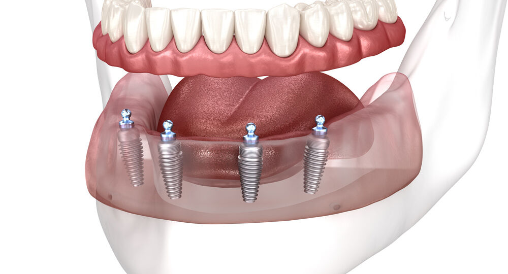 sobredentadura-implantes-leganes