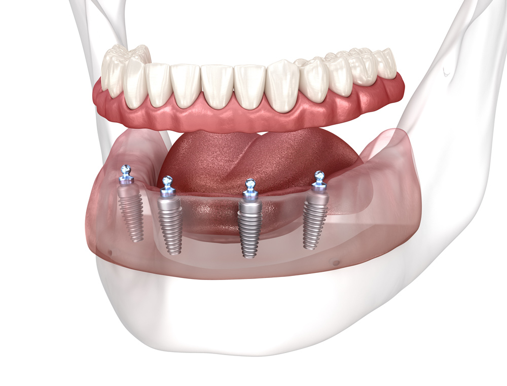 Sobredentadura con Implantes